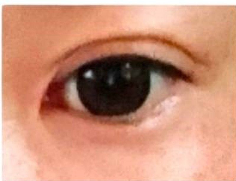 両端を切って二重になったまぶたの写真